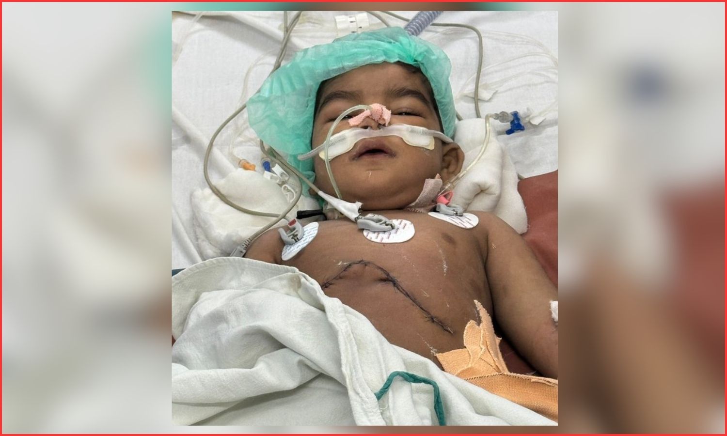 Liver Transplant Success