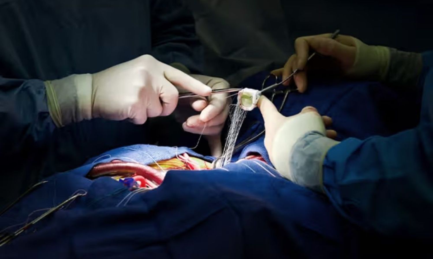 نمس میں بچوں کی کامیاب دل کی سرجری | Pediatric Heart Surgery