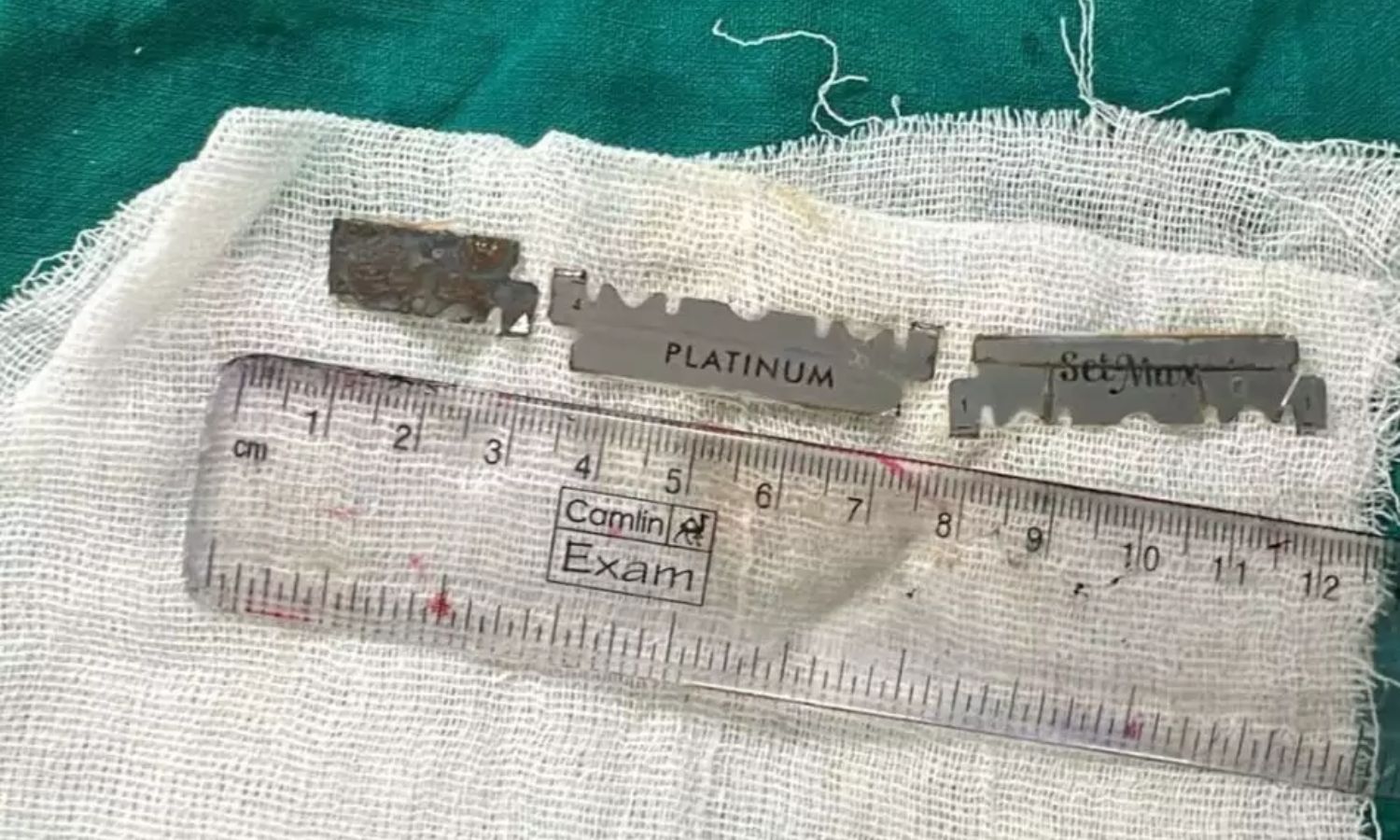 لڑکے کے معدے سے بلیڈ کے ٹکڑے نکالے گے| Endoscopic Treatment